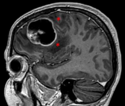 Pro-inflammatory cytokines in cystic glioblastoma: A quantitative study with a comparison with bacterial brain abscesses. With an MRI investigation of displacement and destruction of the brain tissue surrounding a glioblastoma